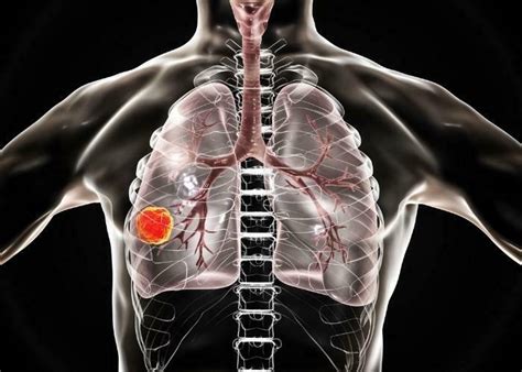 4 seviye akciğer kanseri